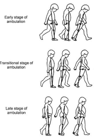 Figure 5: Changes in the ground reaction force vector and joints alignment during loading response, mid-stance and terminal stance in DMD chiidren as the disease progresses