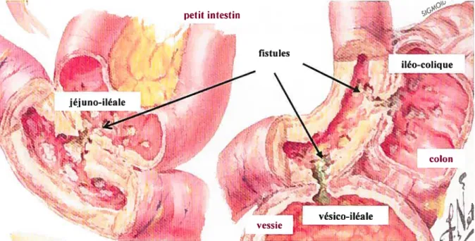 Figure 2 Coupe de fistules intestinales