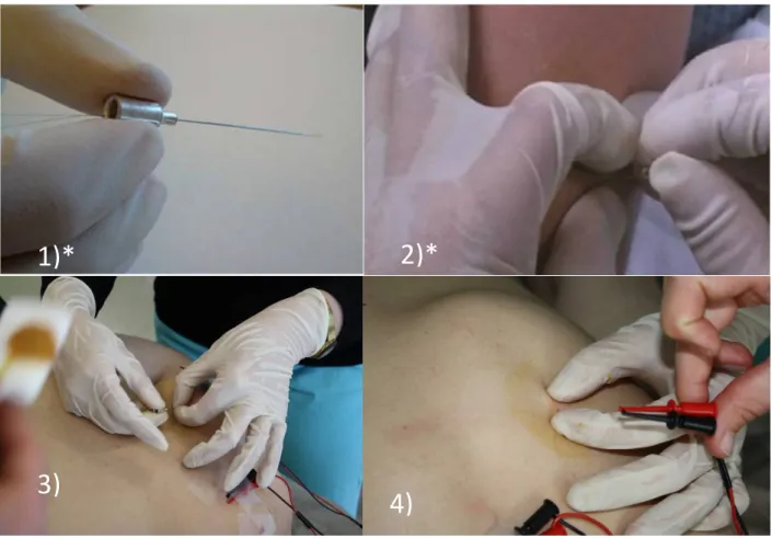 Table 4  presents the advantages and disadvantages of intramuscular EMGs.  Fine wire  electrodes have a small detection area and they record from a more localized area of the muscle,  thus this technique gains a better degree of specificity