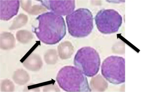 Figure 2: Bone marrow accumulation of lymphoblasts in a pediatric ALL patient. 