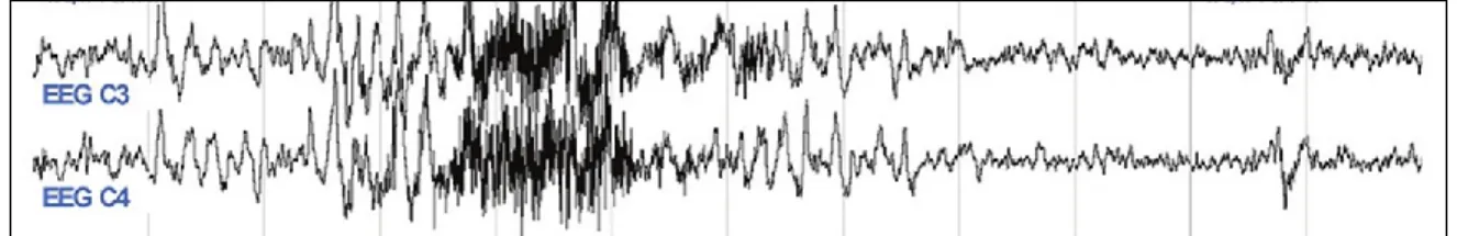 Figure 1.  Exemple d’éveil EEG vu sur un tracé d’EEG 