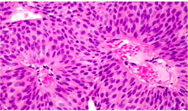 Figure	2.	Image	histologique	de	carcinome	urothélial	papillaire	de	bas	grade		 	