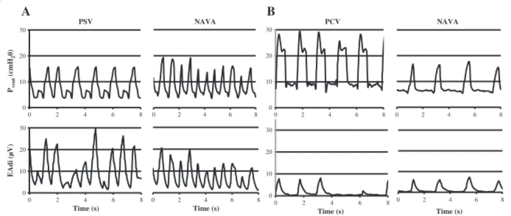 Figure 2 Example of synchronization between ventilator pressure (PVENT) and electrical activity of the diaphragm (EAdi) in two children under NIV