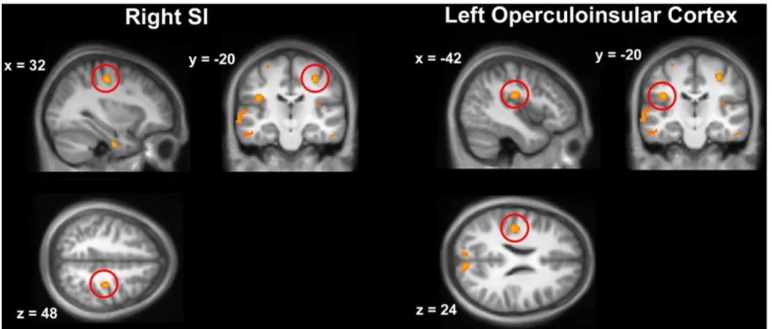 Figure 6. Corrélats neuronaux de l’analgésie visuelle.  Reproduit à partir de Longo et al., 2012