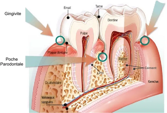 Figure 3: Parodontie dentaire.  