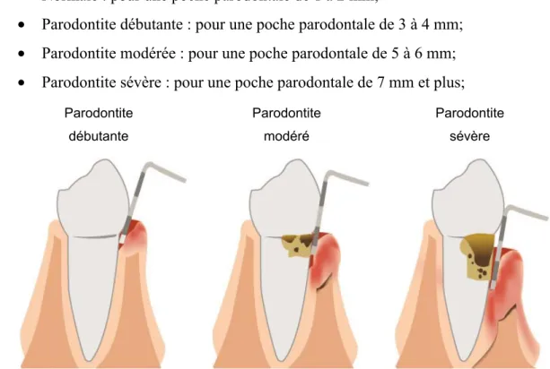 Figure 4: L’évaluation de la sévérité de la parodontie.  