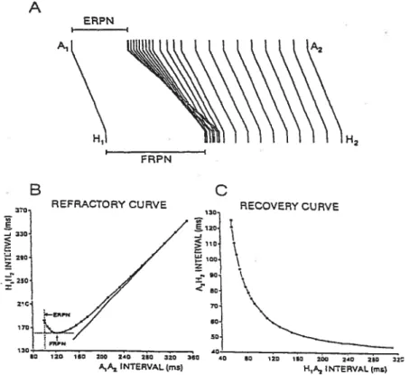 Figure 3 Methods used to characterize AV nodal conduction and refractoriness. A, superimposition, in reference to basic conduction time (A1H1), of prernature