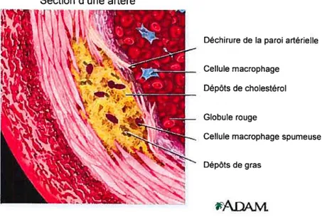 Figure 1.2- Section d’une artère caractérisée par la présence d’athérosclérose. (http:Ilwww.nlrn.n ih.gov/rnedl ineplus/ency/irnagepages/ 1 $01$ .htrn)
