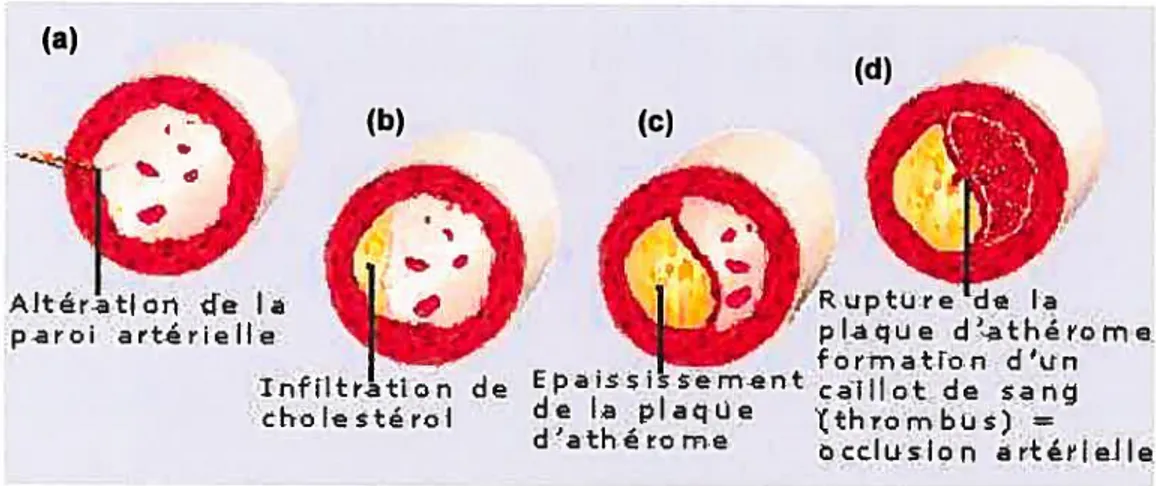 Figure 1.5- Évolution de l’athérosclérose 27 (hftp://www.nsfa.asso.fr/spip.php?article98)