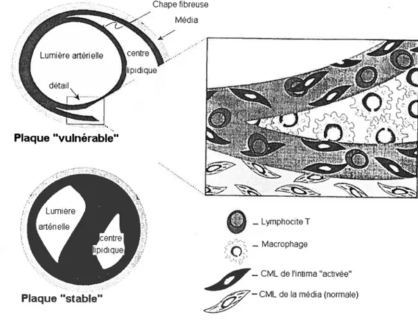 Figure 1.6- Caractéristiques d’une plaque d’athérosclérose « stable » et d’une plaque « vulnérable » 28 CML signifie cellule musculaire lisse.