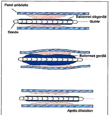 Figure 1.9- Déroulement d’une angioplastie. (http://www.distrirned.com/ffc/ffcl 7q ua.htm I)