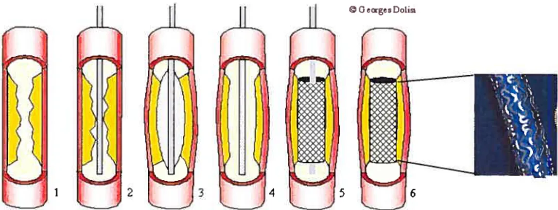 Figure 1.11- Déroulement d’une angioplastie avec pose de stent après l’intervention (exemple du stent Palmaz Corinthïan).