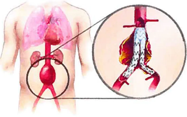 Figure 1 Endoprothèse couverte dans un anévrisme de l’aorte abdominale