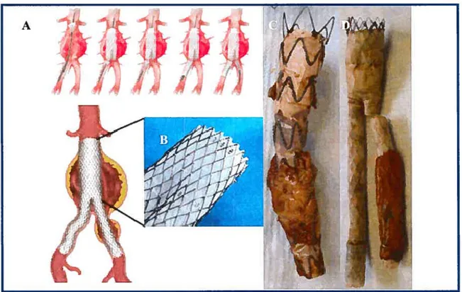 Figure 7: Structure d’une endoprothèse couverte