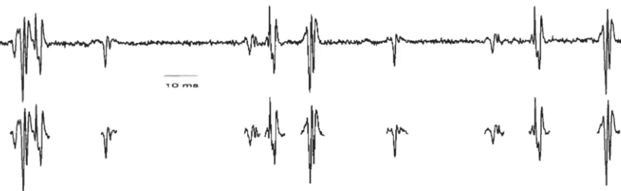 Figure 2.2 — Segmentation d’un signal EMG (haut) en zones d’activité (bas).