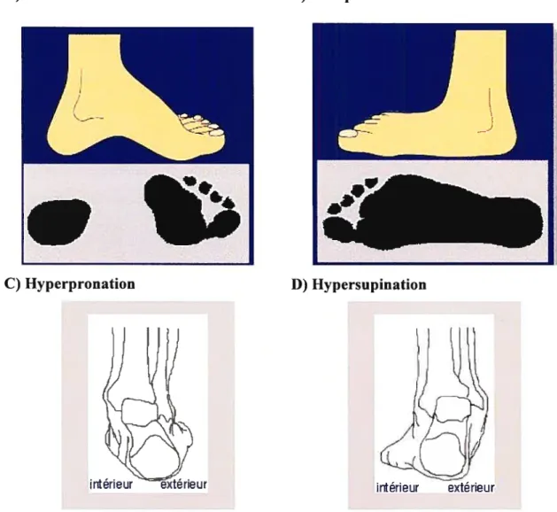 Figure 9- Quelques pathologies du pied. A) pied creux (Pes Cavus), B) pied plat (Pes Planus) C) Hyperpronation, D) ilypersupination
