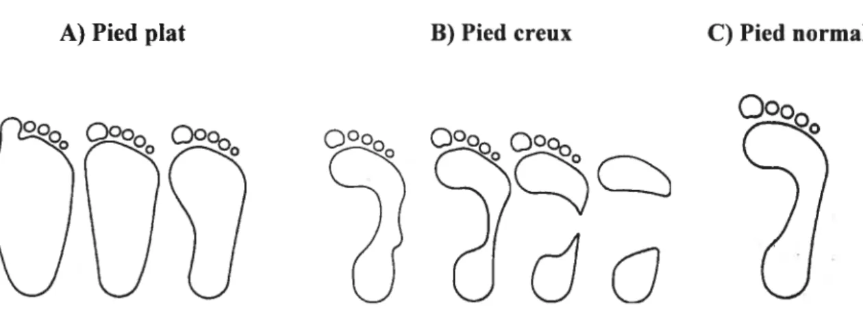 Figure 13 — A) Empreintes du pied plat, B) du pied creux et C) du pied normal 1341