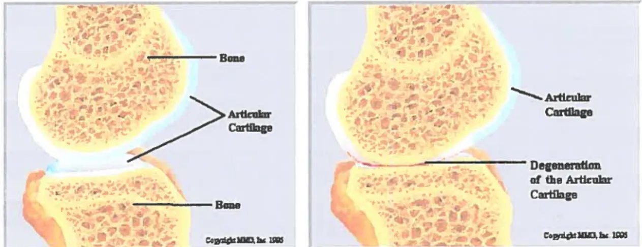 Figure 6 : Schéma représentatif de l’inflammation caractéristique des pathologies d’ordre arthritique, où le cartilage articulaire situé au niveau des joints se dégrade jusqu’au point de dégénération13