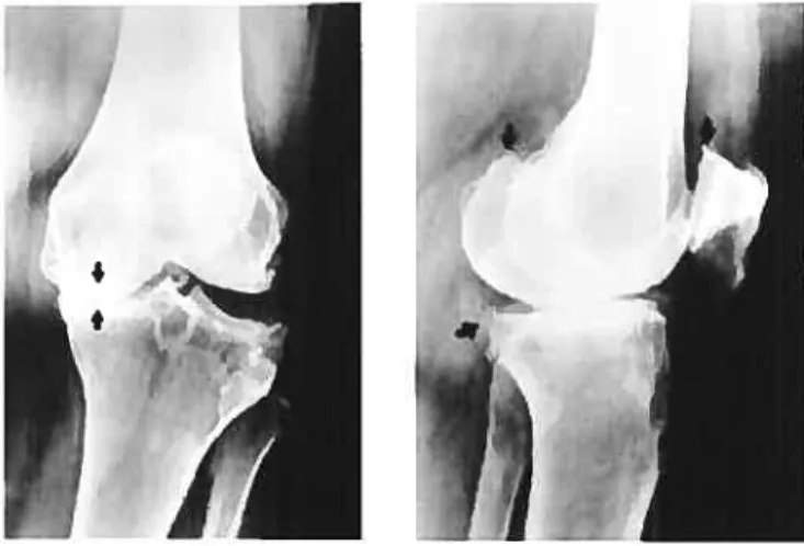 Figure 13 Radiographies de genou arthritique montrant la perte d’espace entre les têtes osseuses fémorale et tibiale