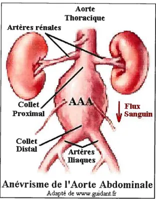 FIG. 1.1 — Réseau artériel péri-aortique et configuration pathologique de l’aorte.