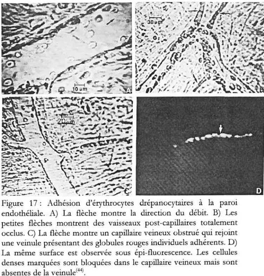 Figure 17 Adhésion d’érythrocytes drépanocytaires à la paroi endothéliale. A) La flèche montre la direction du débit