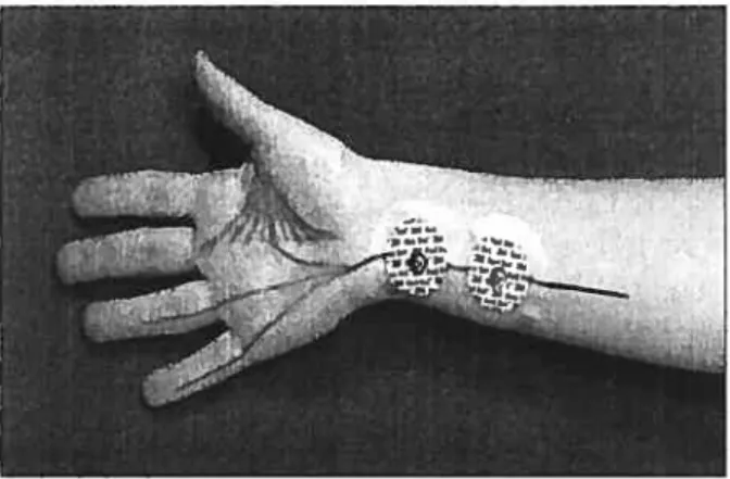 Figure 1: Électrodes de stimulation positionnées sur le nerf ulnaire. La stimulation se fait au niveau du nerf ulnaire via des électrodes de surface, un potentiel d’action est généré et se dé place jusqu’aux jonctions neuromusculaires