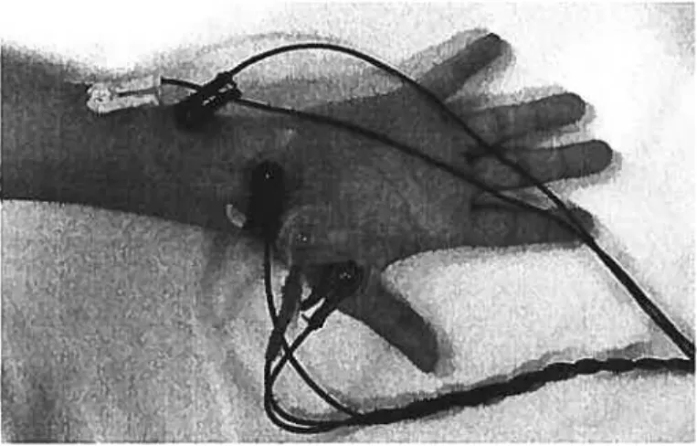 Figure 3: Électromyographie. Les électrodes de stimulation et d’enregistrement sont atta chées à la région des muscles hypothénar permettant de détecter l’activité EMG.