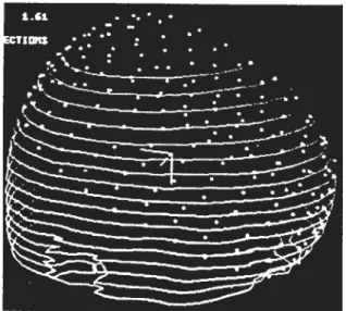 FIG. 4.1 Image tirée de 1431 points IRIVI (chapeau) sont ajustés en fonction du modèle de la tête (contours CT)