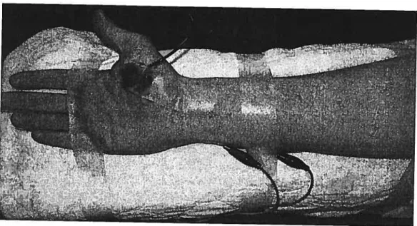 Figure VII: n : Stimulation et enregistrement au site du muscle adducteur du pouce. b : idem pour le muscle sourcilier