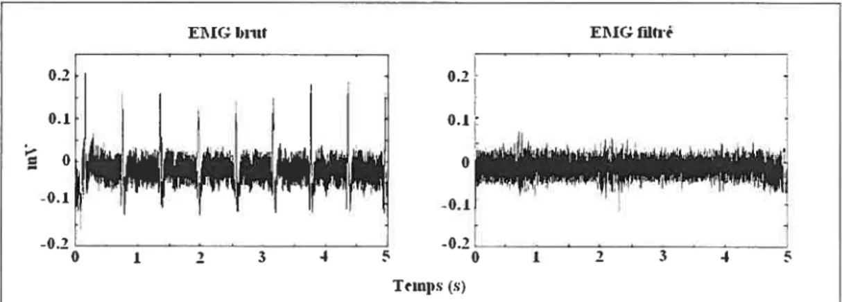 Fig. 3.3 EMG brut et EMG filtré On peut constater que l’activité ECG a été retirée du signal filtré.