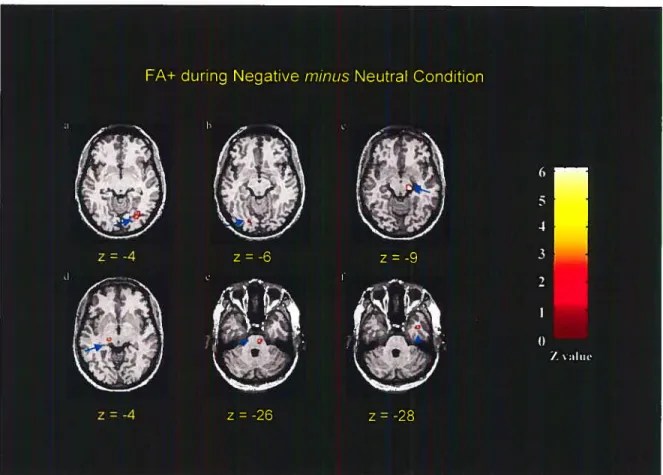 Figure 2. Statistical activation maps in the FA+ group for the Negative minus Neutral contrast: (a) right GOM (BA 19; z= 5.84, pO.OOl corrected), (b) lefi LG (BA 19; z= 5.21, p&lt;O.005 corrected), (e) right midbrain (z4.03, pO.OO3 corrected)