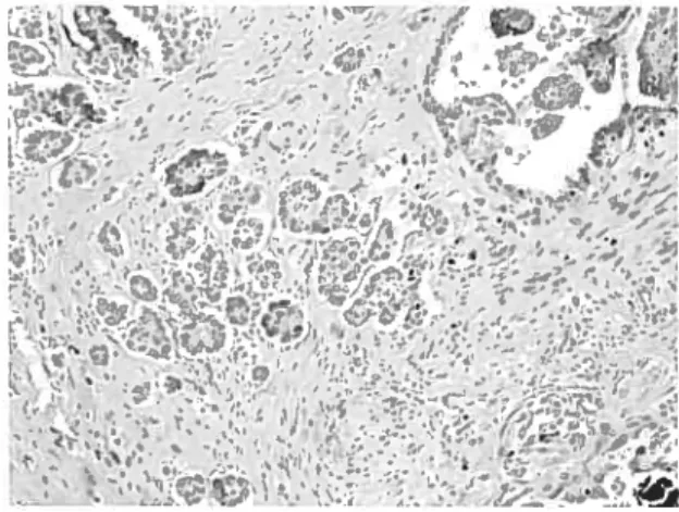 Figure 9 Coupe histologique d’une tumeur à faible potentiel de malignité présentant de la microinvasion (tirée de www.uic.edu/depts/mcpt/anatomicI index.htm)
