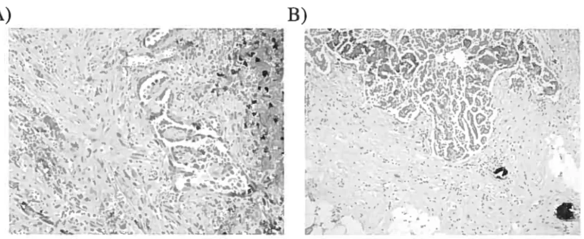 Figure 11 Coupes histologiques d’implants péritonéaux de type non-invasif et invasif associés aux tumeurs à faible potentiel de malignité (tirée de www.uic.eduldepts/mcpt/anatomic/index.htm)