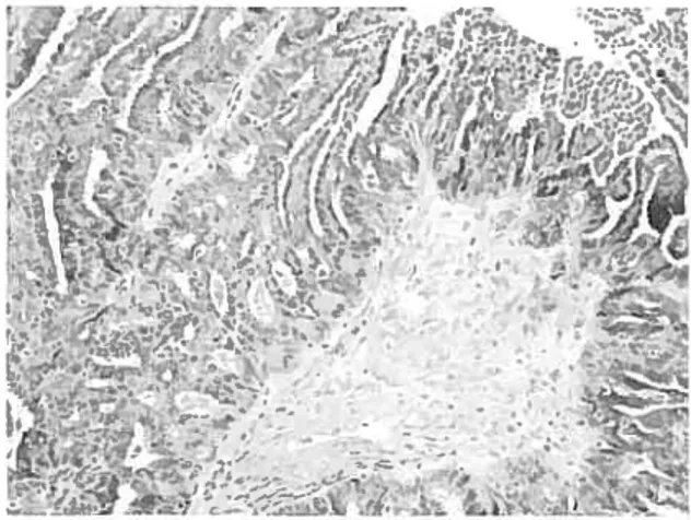 Figure 12 Coupe histologique d’une tumeur à faible potentiel de malignité présentant une architecture de carcinome micropapiliaire séreux (MPSC) (tirée de www.uic.edu/depts/mcpt/anatomic/index.htm)