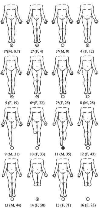 Figure 5 : Progression of amputations in 16 hereditary sensory and autonomic neuropathy type 2 patients according to age