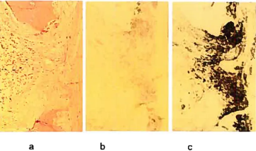 Figure S : Présence de gal-3 lors de l’arthrite rhumatoïde (RA) La gal-3 fut détectée par