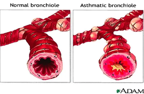 Figure 1 Représentation d’une ramification bronchique chez un individu normal et chez un asthmatique en phase bronchospastique