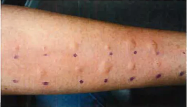 Figure 3 : Tests cutanés d’allergie positifs