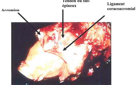 Figure 1.10 : Photo de l’insertion (point bleu) du tendon du sus-épineux passant sous l’arche coracoacromial.
