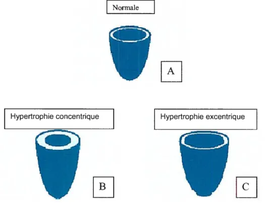 Figure 2: Structure des ventricules dans des conditions normales (A), lors de l’hypertrophie concentrique (B) et lors de J’hypertrophie