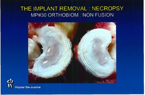 Figure 4: disques intervertébraux avec ostéosynthèse mobile I intervertebral discs with mobile osteosynthesis