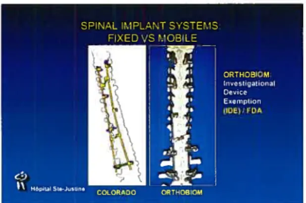 Figure 1: Orthobiom osteosynthesis system