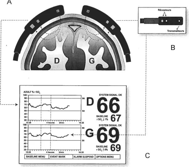 Figure 7. Positionnement des électrodes et représentation des ondes émises par le spectroscope à infrarouge (A), électrode (B) et écran d’affichage (C)