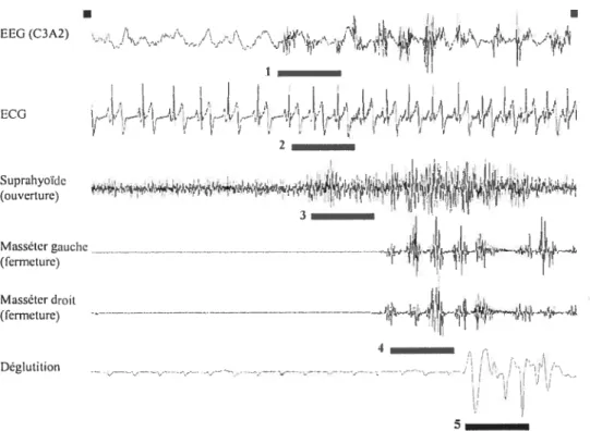 Figure 5 - Séquence d’évènements associés à un épisode de bruxisme. (1)