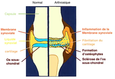 figure 1 : L’articulation normale et arthrosique. Disposition des tissus articulaires (membrane synoviale, os sous-chondral et cartilage) et leurs modifications au cours de l’arthrose