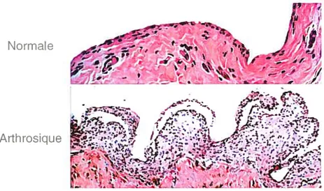 Figure 2: la membrane synoviale normale et arthrosique