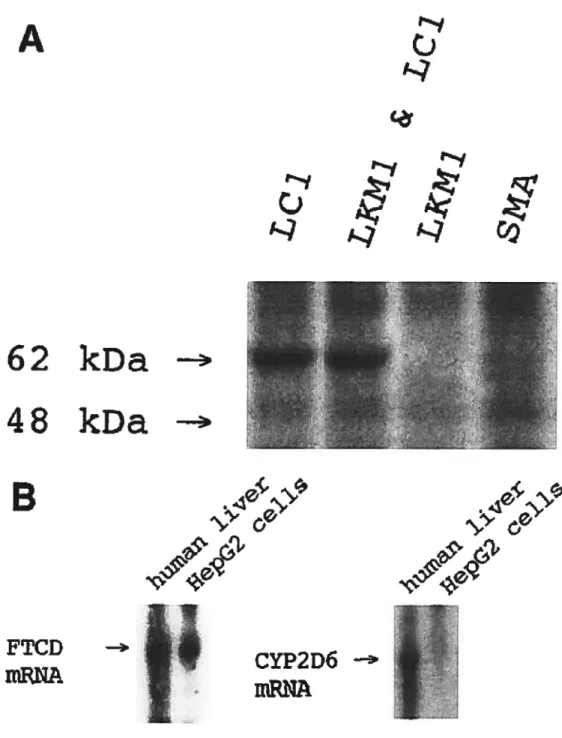 Figure 1: Human hepatoma HepG2 ceil une expresses the LCI antigen. A) a 62-kilodaton (kDa) in 10% SDS-PAGE is immunoprecipitated by anti-LC1 and LKM1/LC1 positive sera from (S )cystein-Iabeled HepG2 proteins