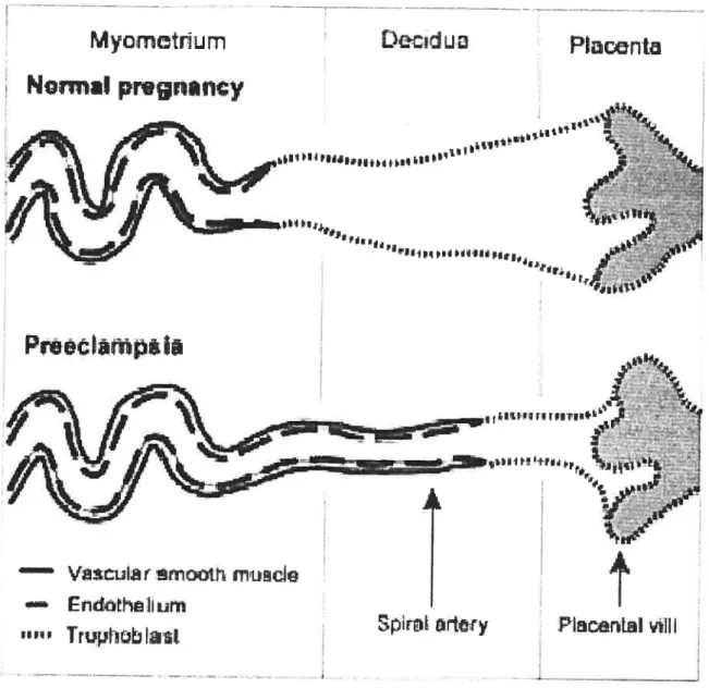 Figure 7. Trophobalst invasion into the spiral arteries in the placental bed in normal pregnancy and in preeclarnpsia