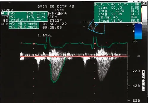 FIG. 3.3 — Mesure de la vitesse clans la vena contracta \‘c par échocardiographie