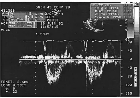 FIG. 3.4 — Mesure de la vitesse dans la chambre de chasse ventriculaire VLV par